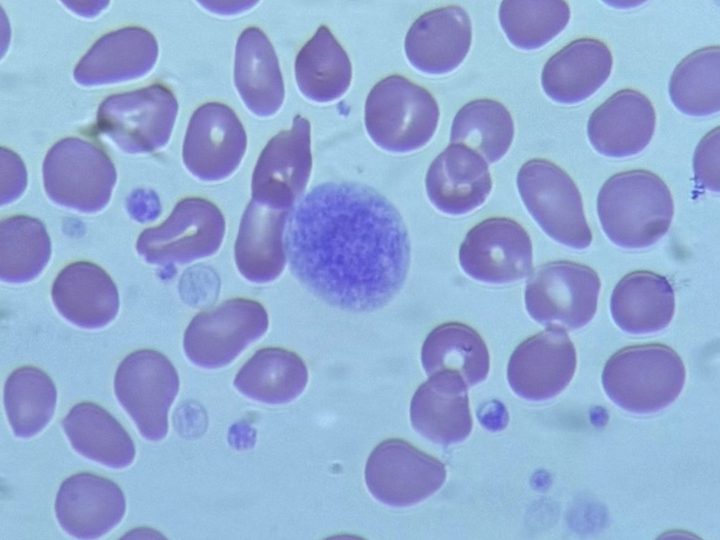 Blood smear: naked megakaryocyte nucleus surrounded by poikilocytes and dacryocytes