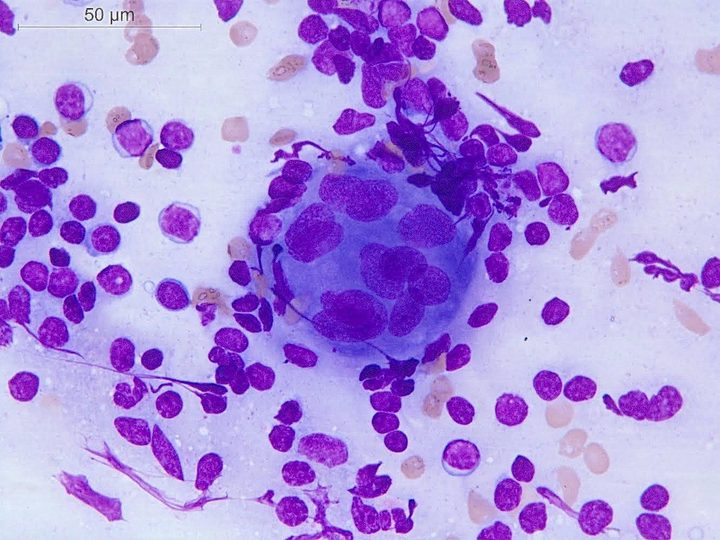 Цитологический отпечаток: многоядерная гигантская клетка в окружении гистиоцитов