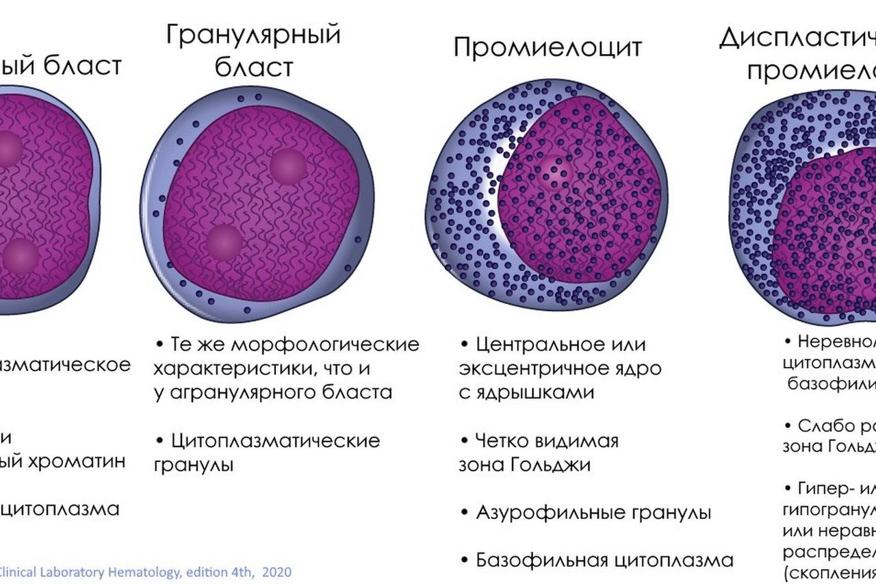 Гранулярные бласты и промиелоциты: морфология при МДС