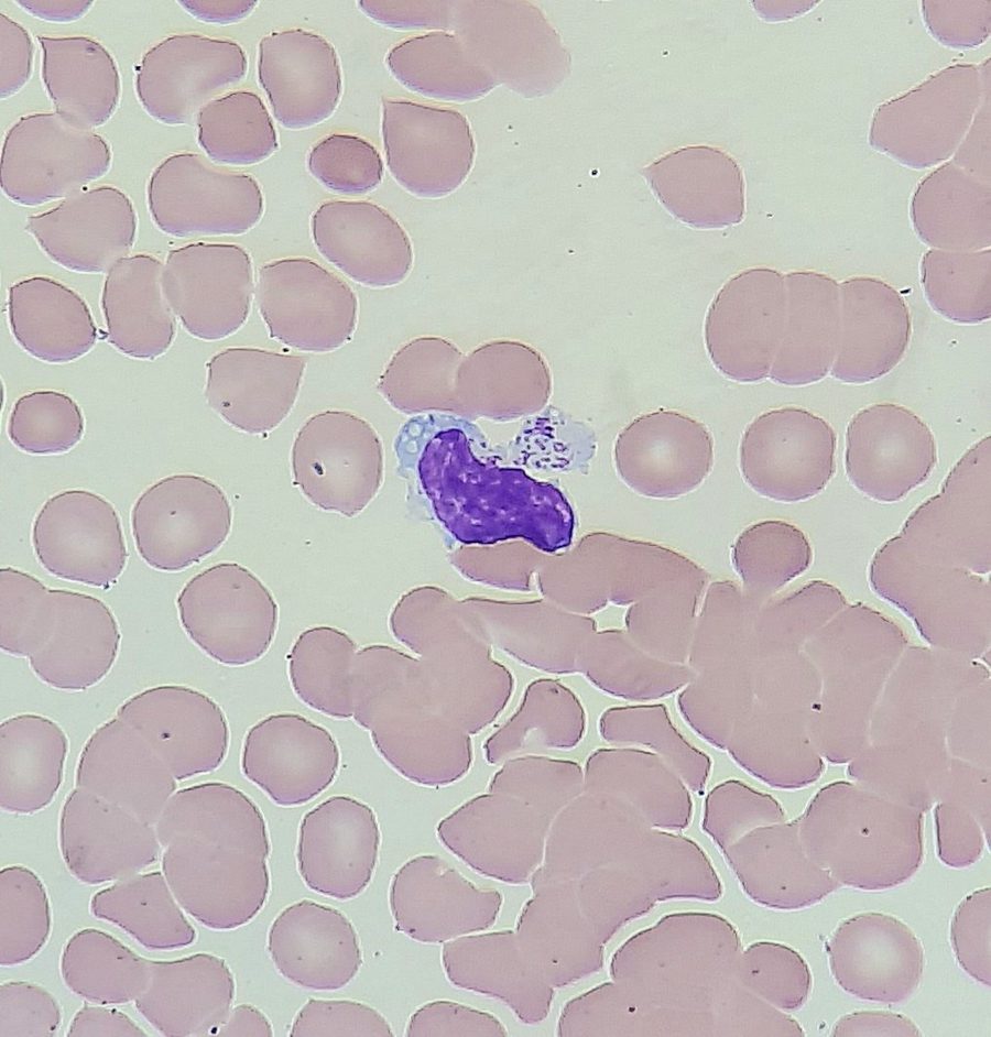 Холодовая агглютинация эритроцитов при Mycoplasma pneumoniae