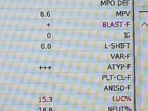 Распечатка анализатора: ложное завышение MCHC до 47,4 г/дл из-за агглютинации