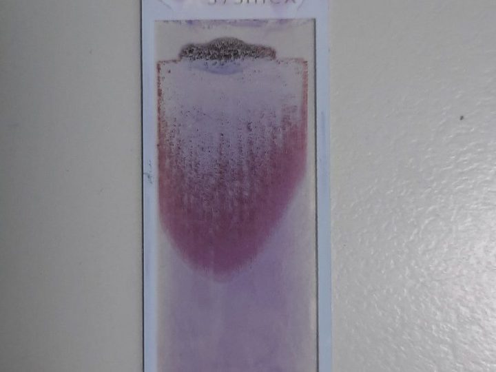 Blood smear on a slide: uneven granular distribution