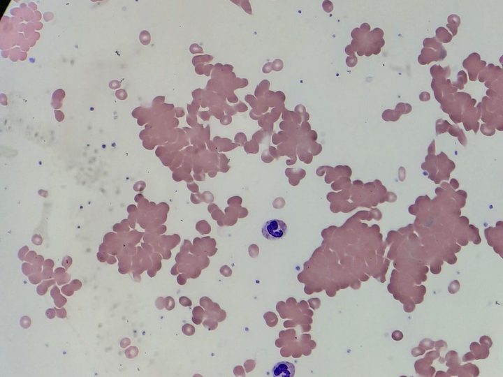 Blood smear, microscopy: large clusters of agglutinated erythrocytes