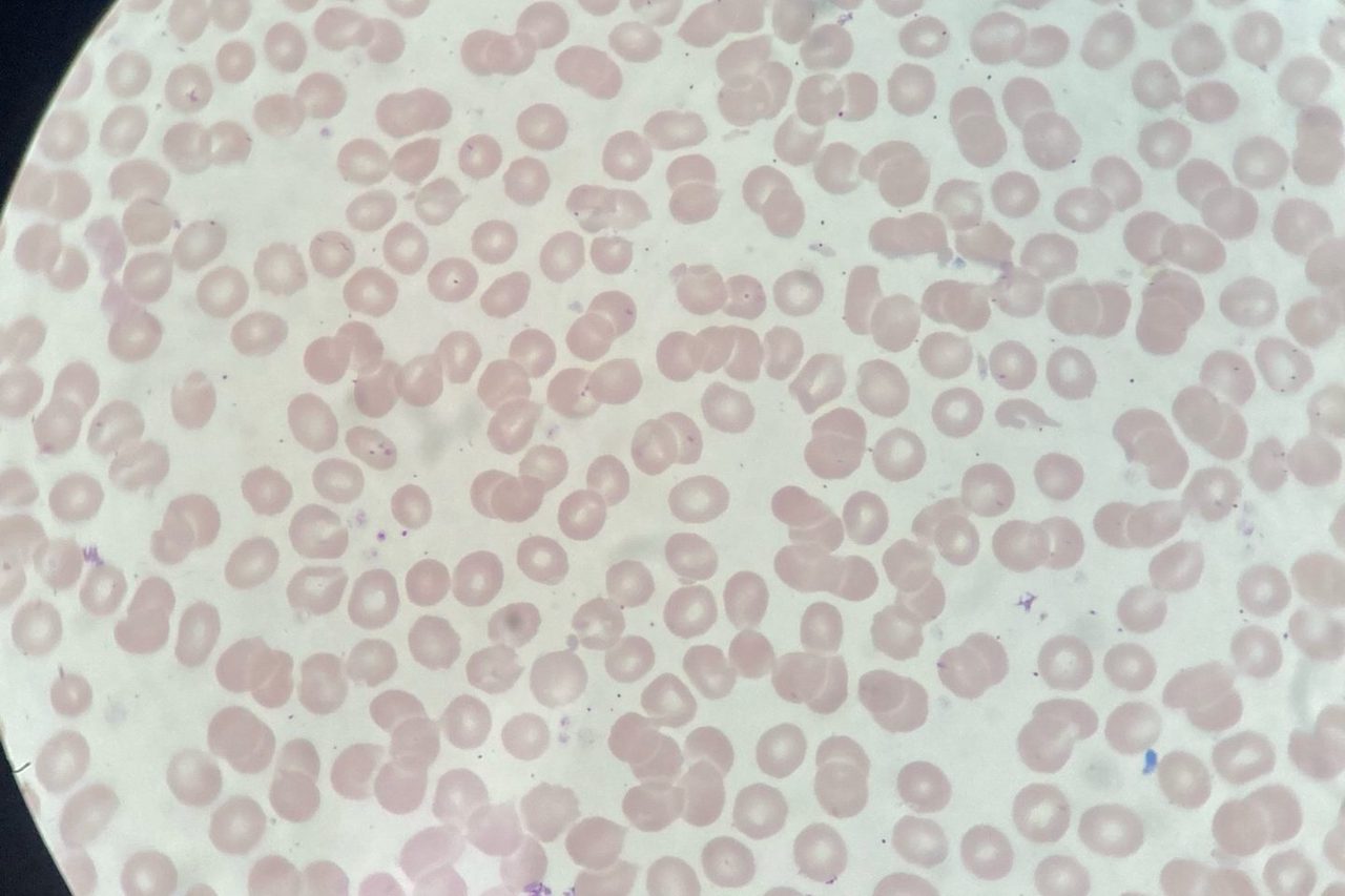 Erythrocyte Chromia: Normochromia, Hypochromia, Hyperchromia