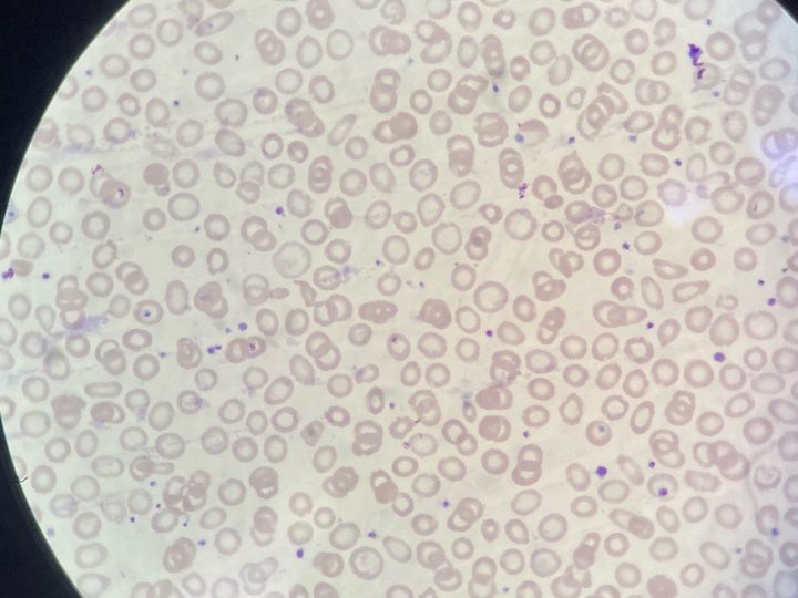 Blood smear: pronounced hypochromia of erythrocytes with sharp expansion of the central zone