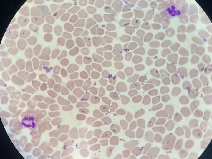 Blood smear: hyperchromic erythrocytes without pronounced central pallor
