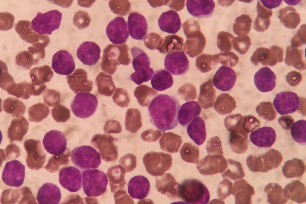 Chronic Lymphocytic Leukemia: A Diagnostic Case Study