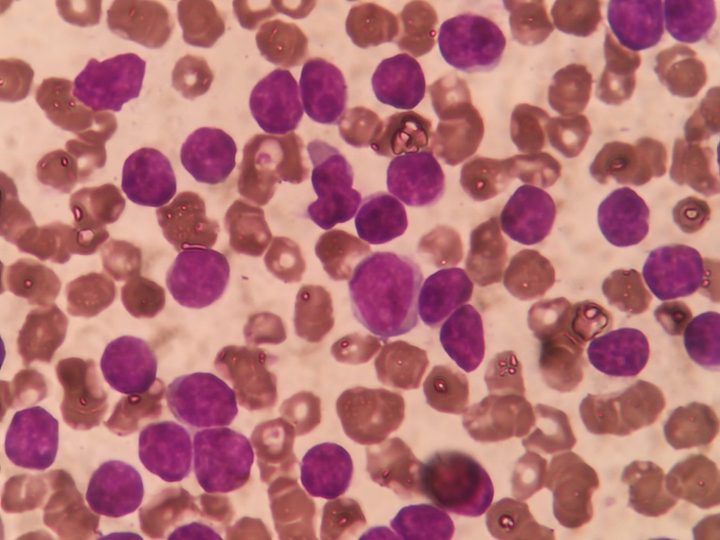 CLL blood smear: small mature lymphocytes predominate