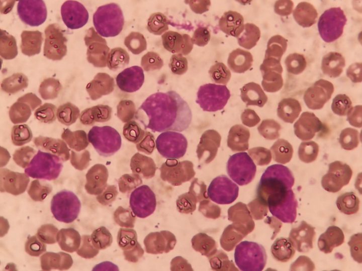 Lymphocytes of varying size in a CLL patient's blood smear