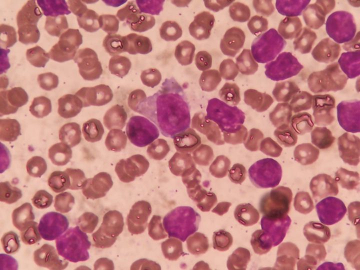 Lymphocytes and a smudge cell in the blood smear