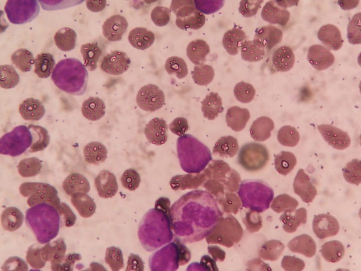 CLL blood smear: lymphocytes of varying size and smudge cells