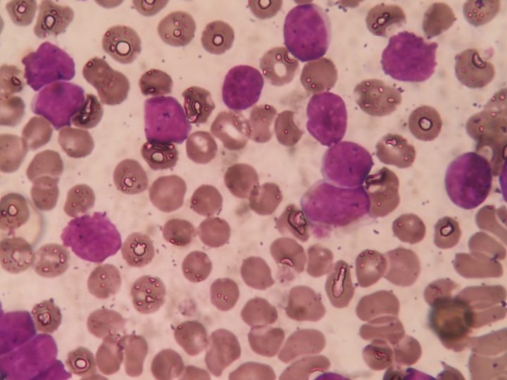 Lymphocytosis in chronic lymphocytic leukaemia, another field