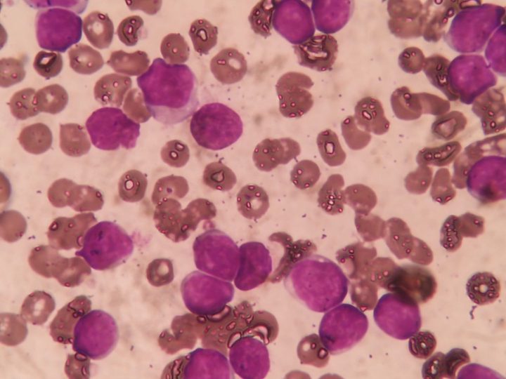 Clusters of lymphocytes in a CLL patient's blood smear