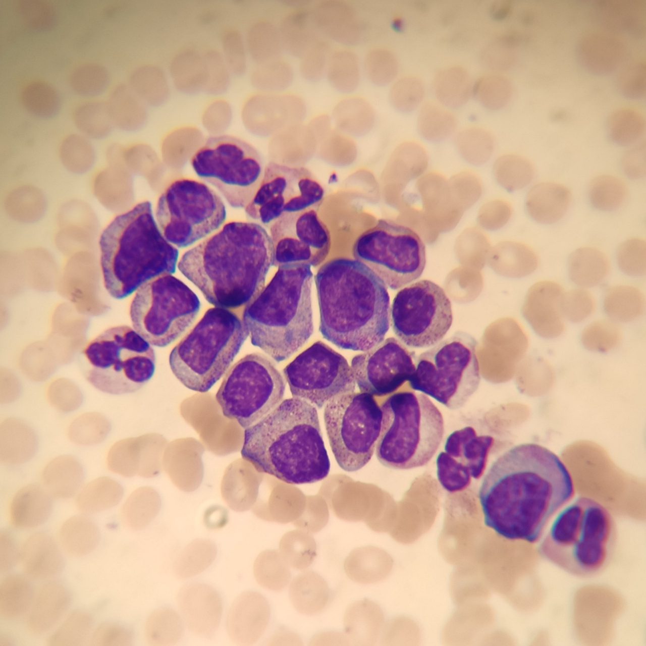 Chronic Myeloid Leukemia: Blood and Bone Marrow Picture