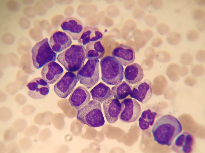 Peripheral blood smear: accumulation of granulocytes at all stages of maturation