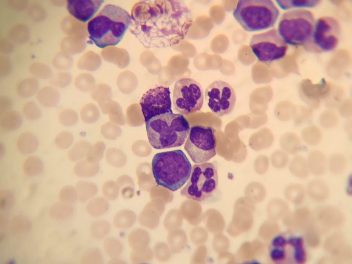 Peripheral blood smear: myelocytes, basophil, and segmented neutrophils