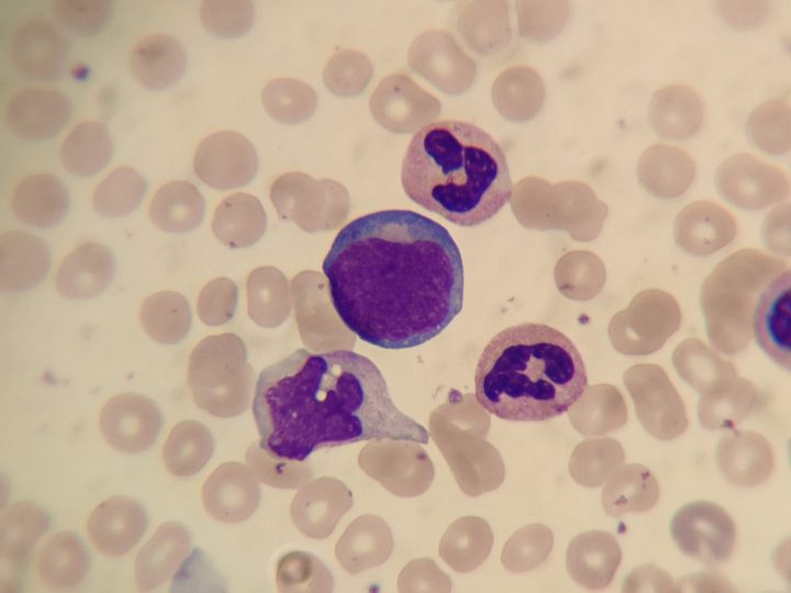 Peripheral blood smear: blast cell, monocyte, and neutrophils
