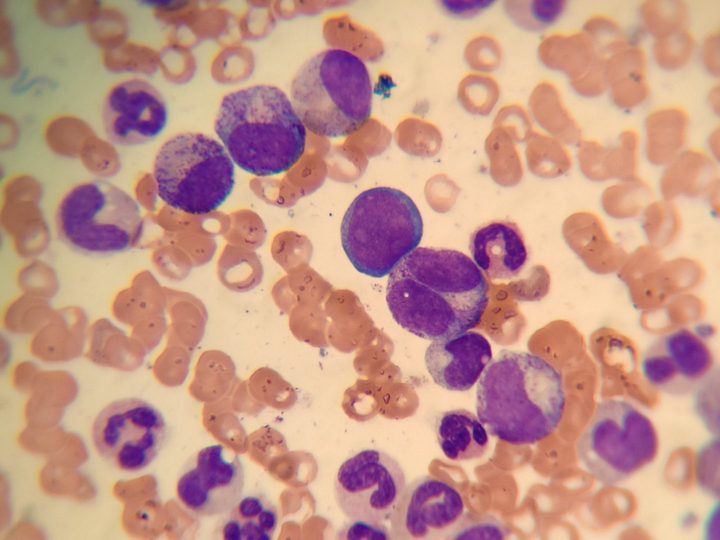 Bone marrow smear: myeloid hyperplasia with left shift