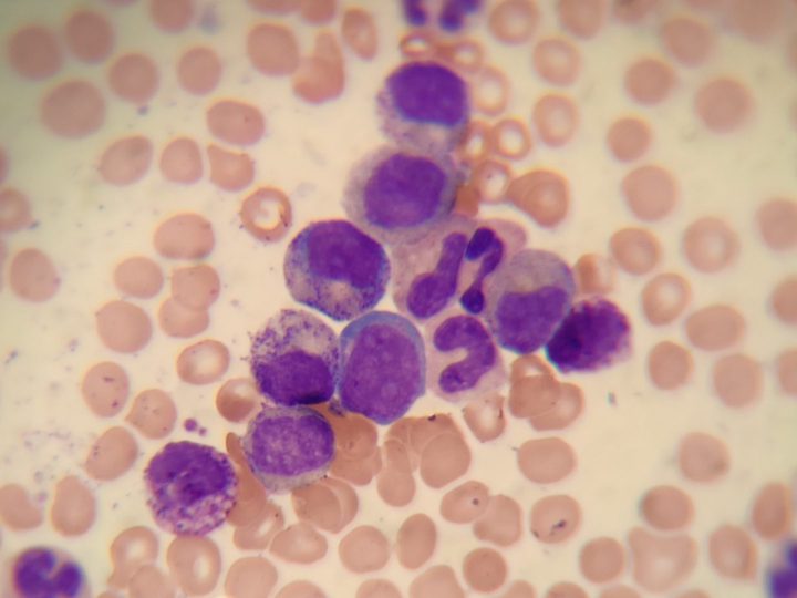 Bone marrow smear: group of promyelocytes, myelocytes, and metamyelocytes