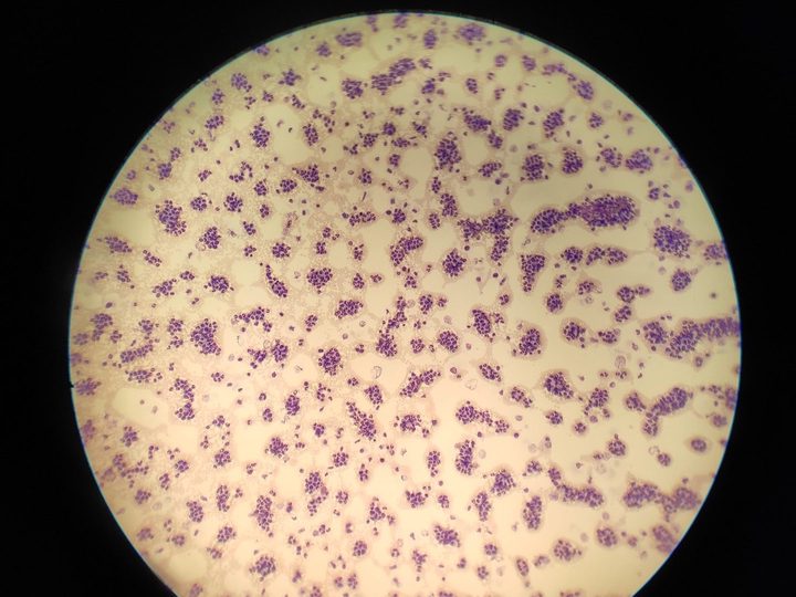Peripheral blood smear, low magnification: marked hyperleukocytosis