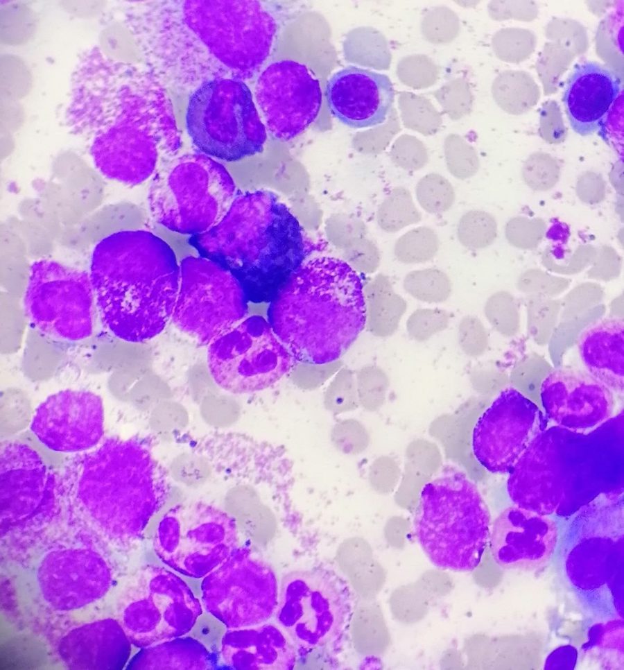 Chronic Myeloid Leukemia: Blood and Bone Marrow Picture