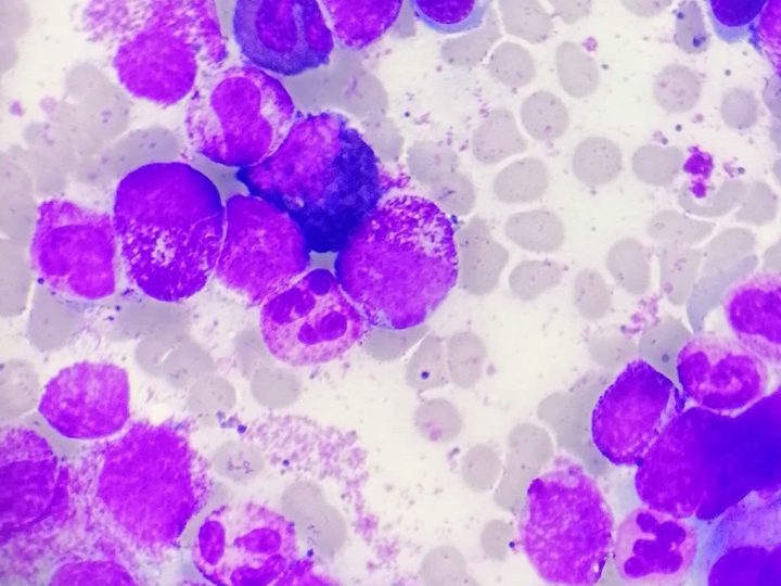 Bone marrow smear in CML: granulocytic hyperplasia
