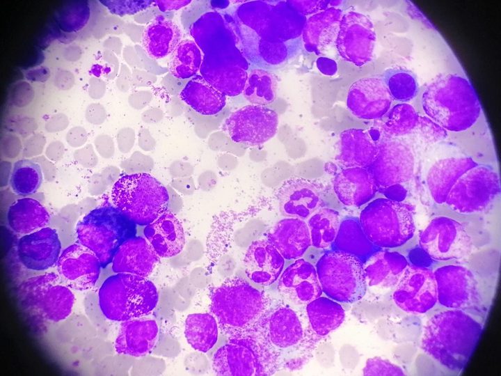 Bone marrow smear: polymorphic composition with myeloid cell predominance