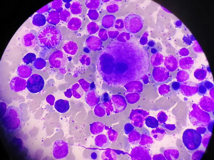 Bone marrow smear: mature megakaryocyte and mitotic figure in the field of view