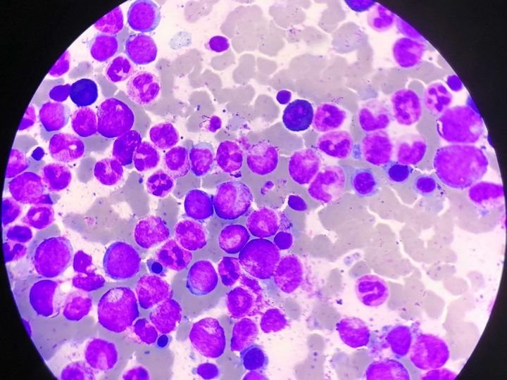 Bone marrow smear: high cellularity and maturing granulocytes