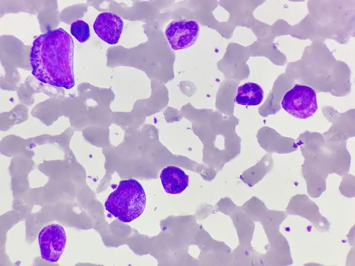 Blood smear: leukocytosis with a left shift to myelocytes