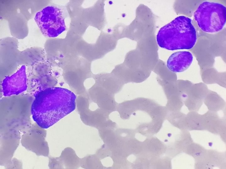 Peripheral blood smear: granulocytes at different stages of maturation