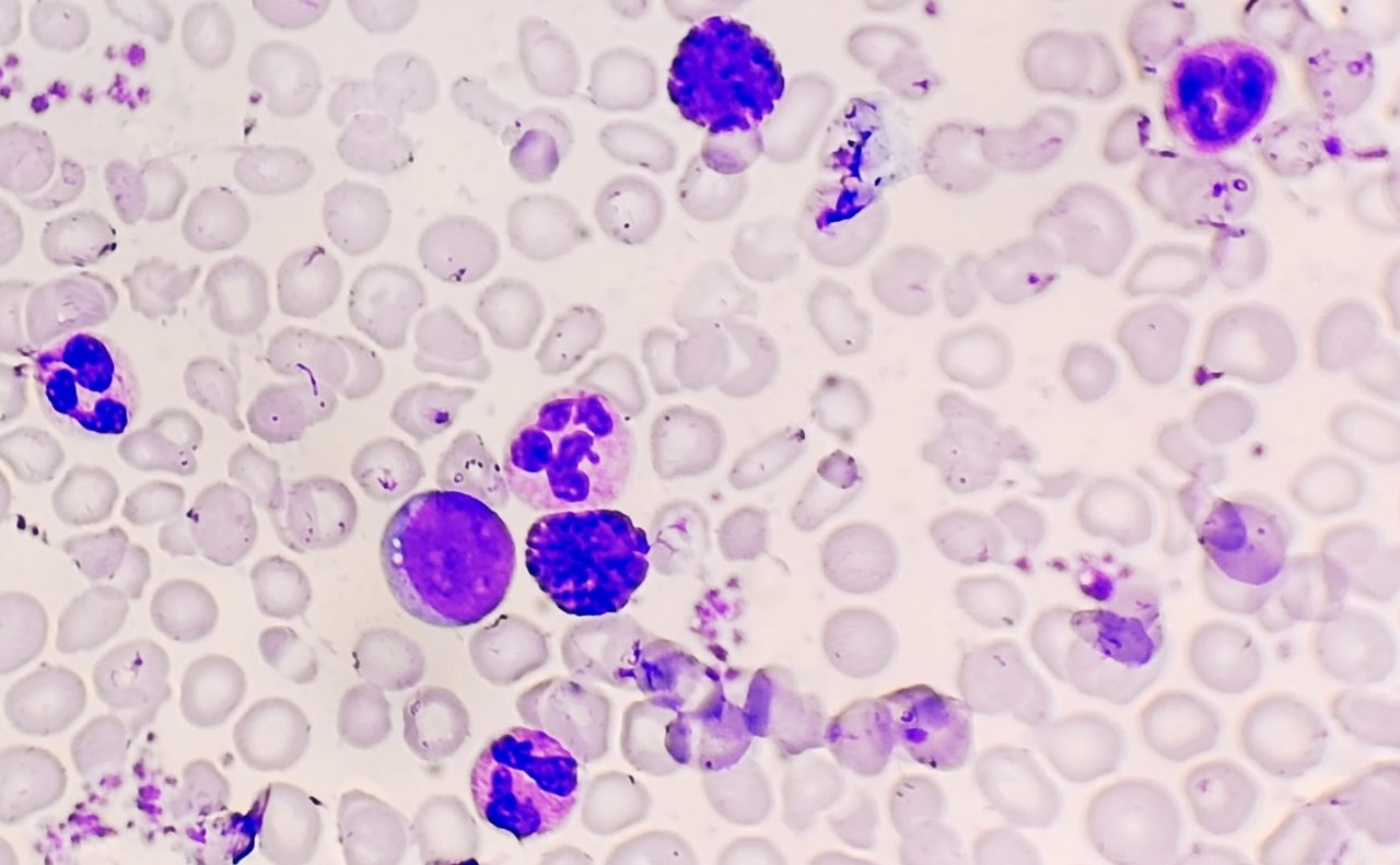Chronic Myeloid Leukemia: Peripheral Blood Picture