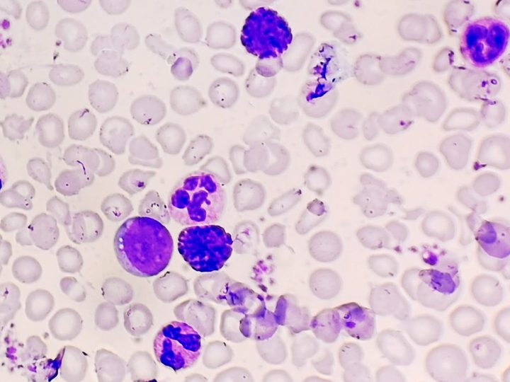 Blood smear: basophil with abundant granulation, neutrophils, and an immature cell