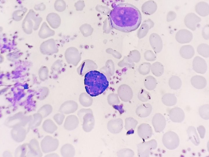 Blood smear: blast cell and mature basophil in the field of view
