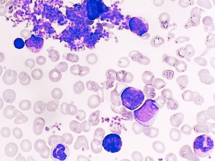 Blood smear: large platelet aggregate, basophil, and granulocyte precursors