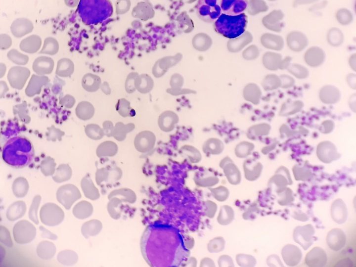 Blood smear: marked hyperthrombocytosis with platelet clumps and a blast