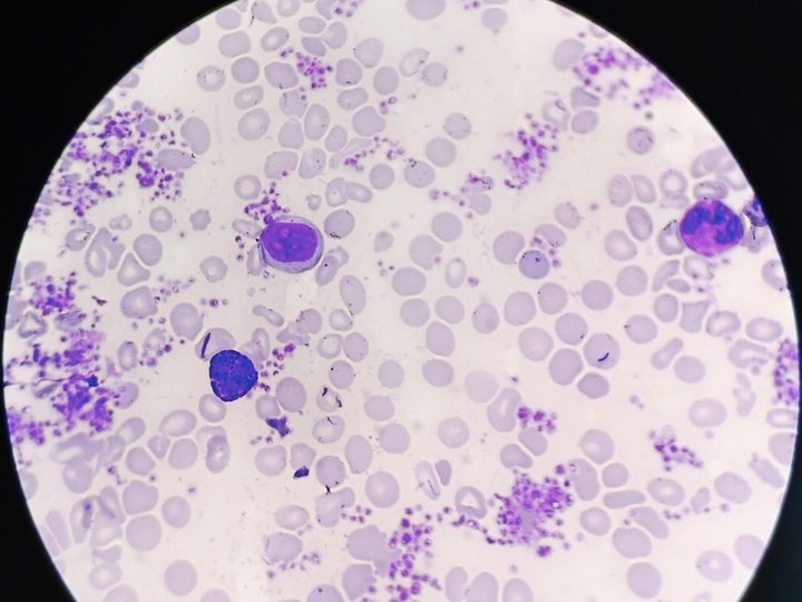 Blood smear: abundance of platelets in the field of view, basophil, and myeloid elements