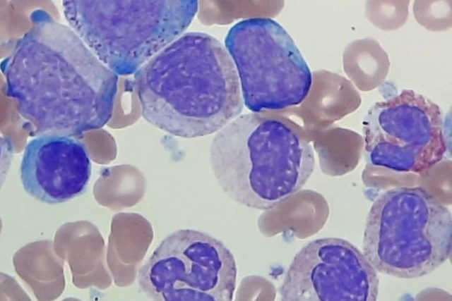 Chronic Myeloid Leukemia: Peripheral Blood Morphology