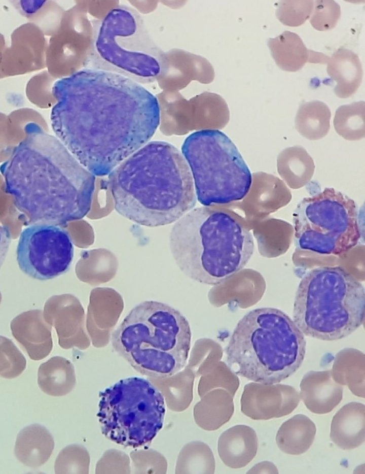 Peripheral blood smear: granulocytes at different maturation stages in CML