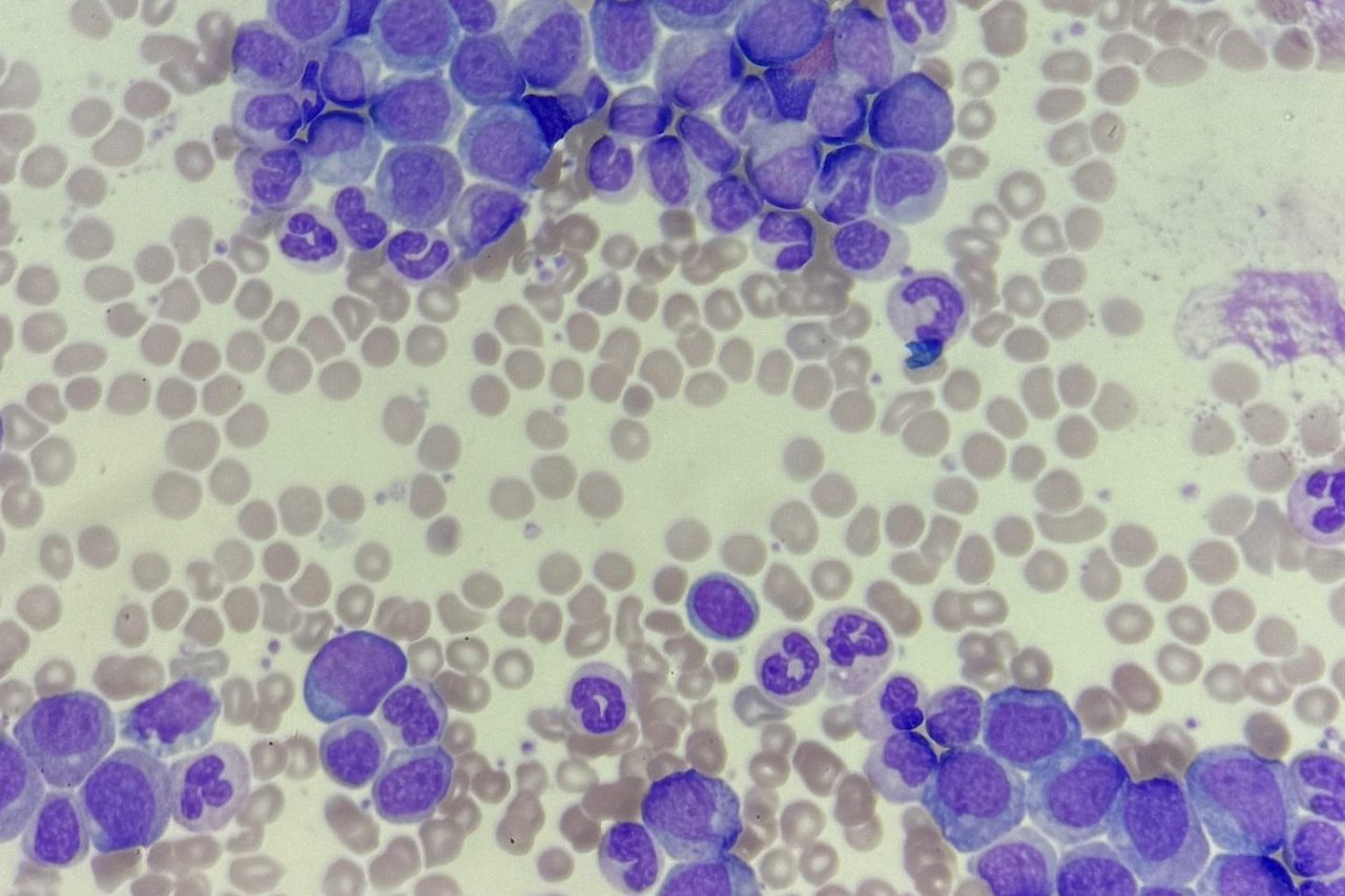 Chronic Myeloid Leukemia in a Peripheral Blood Smear