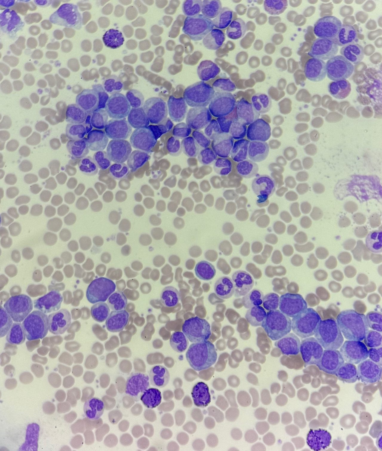 Chronic Myeloid Leukemia in a Peripheral Blood Smear