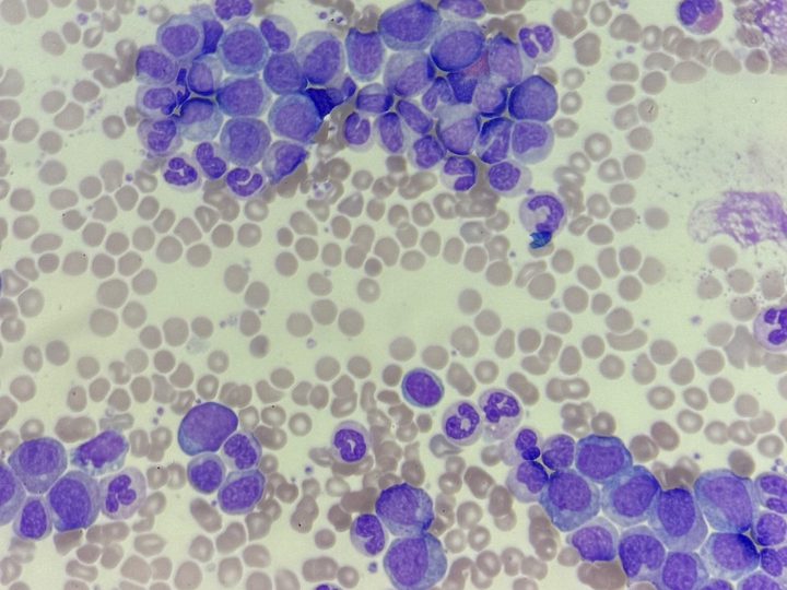 Blood smear: cluster of immature granulocytes, promyelocytes and myelocytes