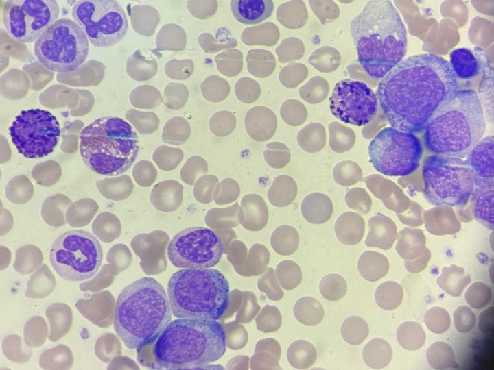 Blood smear: normoblast, basophil and neutrophil precursors