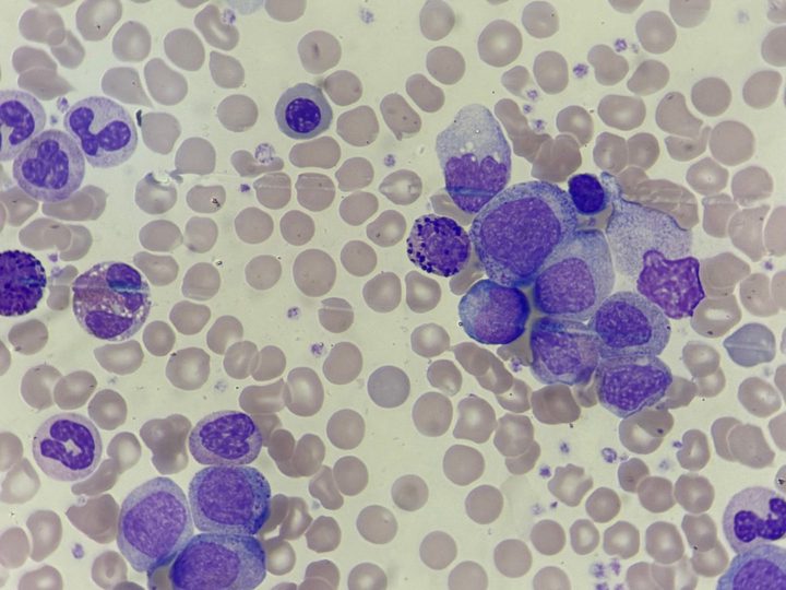 Blood smear: oxyphilic normoblast, myelocytes and band neutrophil