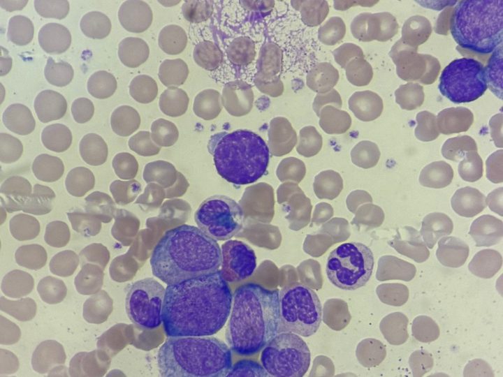 Blood smear: disintegrated cell, myelocytes, metamyelocytes and blast