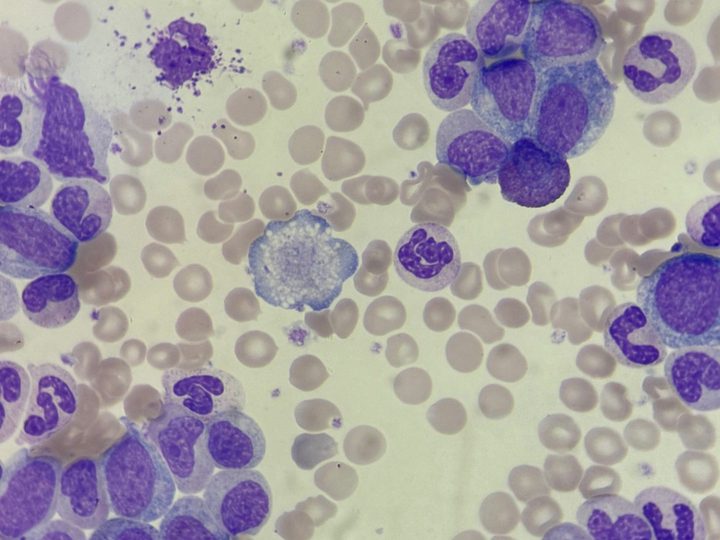 Blood smear: micromegakaryocyte in the center of the field of view and immature granulocytes