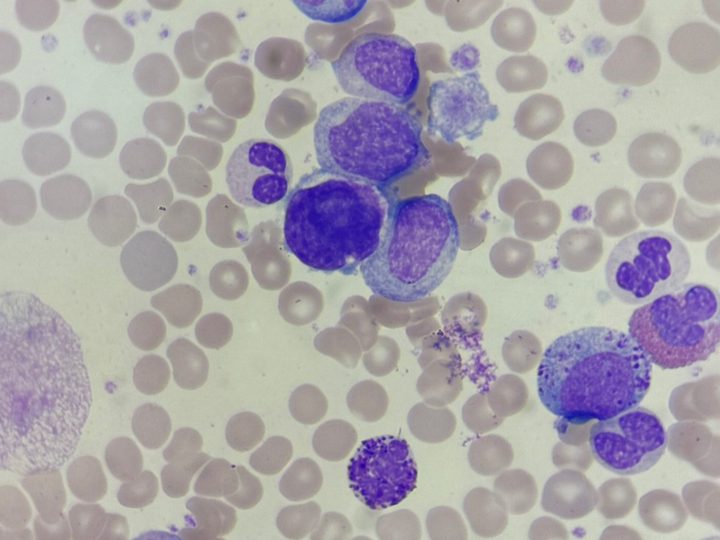 Blood smear: basophil with characteristic granulation, eosinophil and myelocytes
