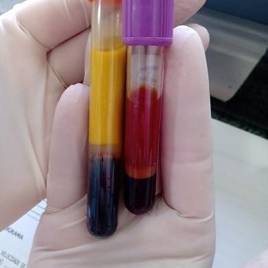 Hook Effect in Blood Biochemistry: Understanding & Avoiding