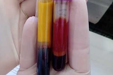 Hook Effect in Blood Biochemistry: Understanding & Avoiding