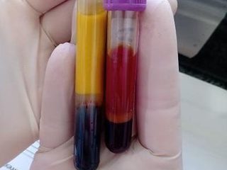 Patient's tubes: icteric serum and an EDTA blood sample